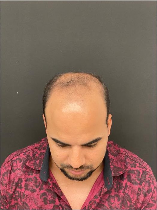 Caso 02, antes: vista superior com calvície avançada no topo