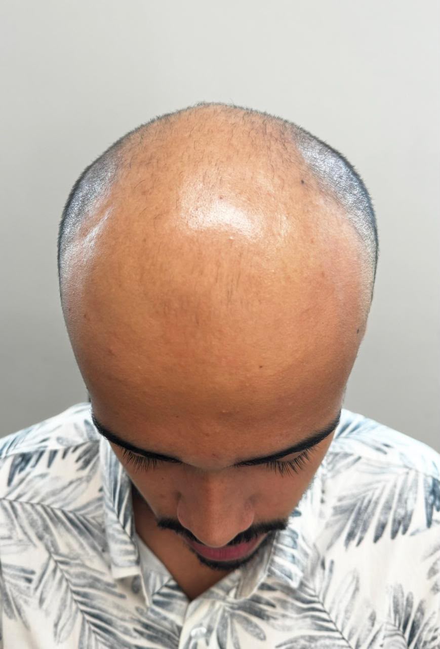 Caso 01, antes: vista superior mostrando rarefação no topo